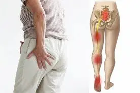 جلسة علاج عرق النسا بالحجامة في مركز الراقي بالرس والقصيم